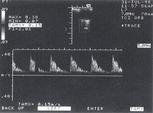 Ultrasunetele Doppler ale vaselor de ochi cu glaucom - petruhina a