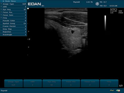 Dus 60 edan - aparat ultrasunete portabil alb-negru cu doppler cu impulsuri