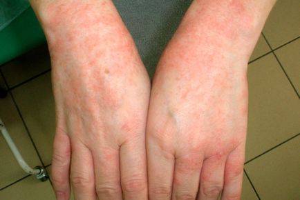 Eczemă la vârstnici, simptome și diagonală
