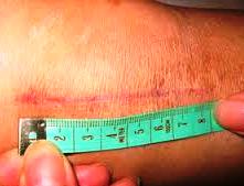 Endoproteticele articulației genunchiului - procedură minim invazivă