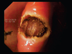 Tratamentul endoscopic al diverticulului markerului