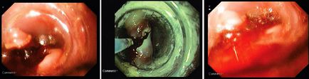 Tratamentul endoscopic al diverticulului markerului