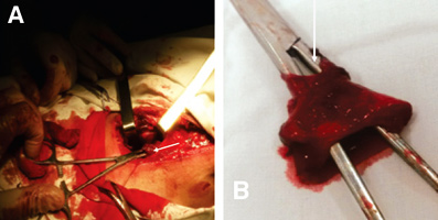 Tratamentul endoscopic al diverticulului markerului