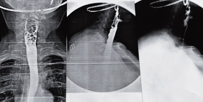 Tratamentul endoscopic al diverticulului markerului