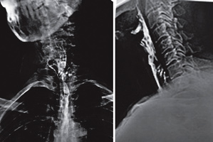 Az endoszkópos kezelés Zenker diverticulum