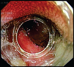 Tratamentul endoscopic al diverticulului markerului