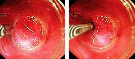 Tratamentul endoscopic al diverticulului markerului