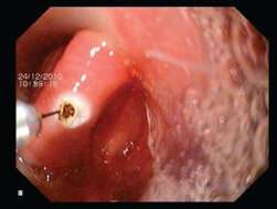 Tratamentul endoscopic al diverticulului markerului