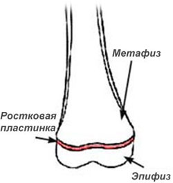 Epifizezioza - fracturi în zona osului de creștere osos