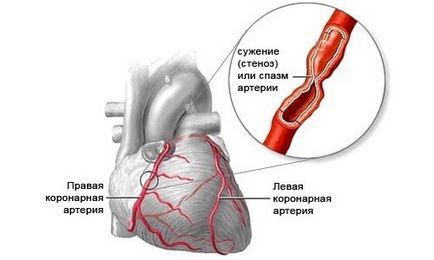 Etiologia și patogeneza anginei pectorale