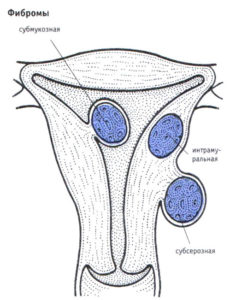 Фіброма матки лікування народними засобами без операції як лікувати