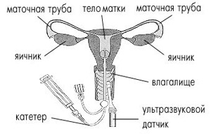 Гідротубація - дослідження прохідності маткових труб