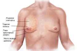 Гінекомастія у чоловіків стадії, причини, методи лікування