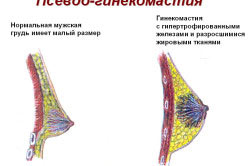 Гінекомастія у чоловіків стадії, причини, методи лікування