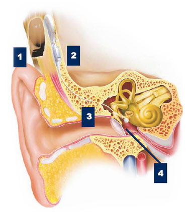 Implant de ureche medie