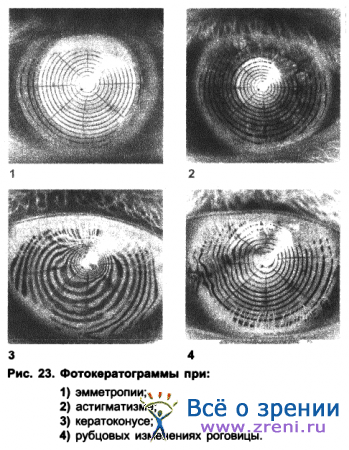 Investigarea formei corneei