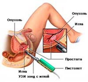 Cum funcționează ecografia prostatei și cum se face - enciclopedia medicală