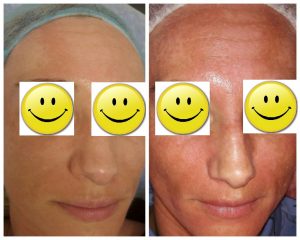 Hogyan lehet megszabadulni a pattanások, akne és nyomokban pigmentáció az arcon