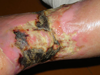 Як лікувати трофічну виразку на ногах, чи допоможуть народні засоби лікування і очищення трофічних