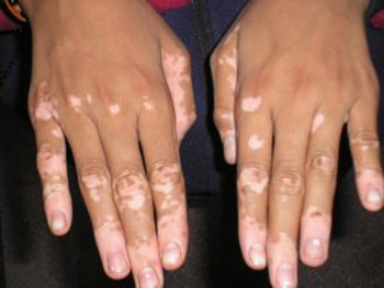 Hogyan kezeljük Vitiligo népi jogorvoslati kezelésére vitiligo