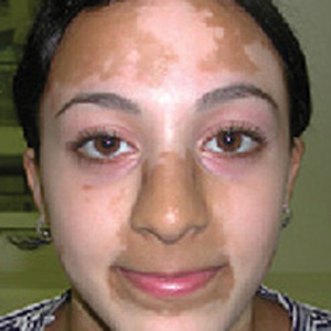 Cum de a trata vitiligo remedii folk în tratamentul vitiligo