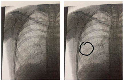 Cum se determină fracturarea nervului prin decodificarea imaginilor cu raze X ale raze X