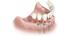 Як зубні протези можуть вплинути на здоров'я людини, все новости стоматології