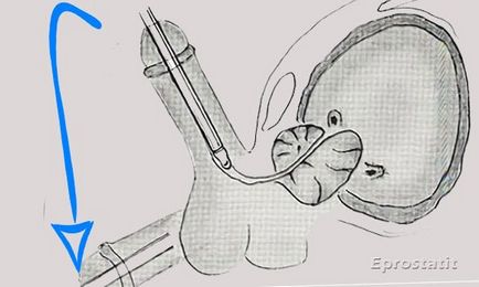 Calculous prostatitis - tünetek és a kezelés a betegség