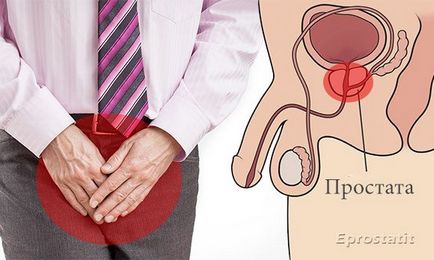 Calculous prostatitis - tünetek és a kezelés a betegség