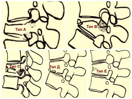 Класифікація переломів хребта в залежності від механізму ушкодження