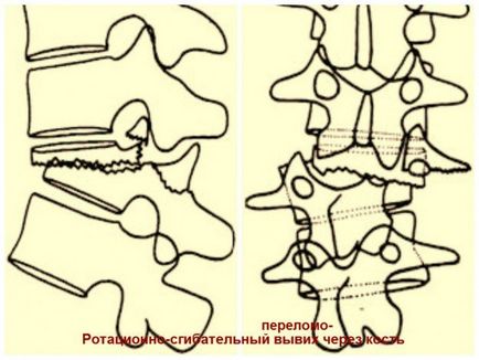 Класифікація переломів хребта в залежності від механізму ушкодження