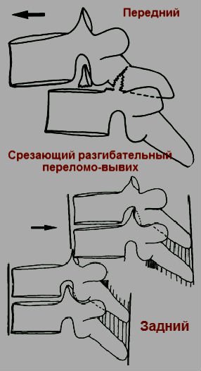 Класифікація переломів хребта в залежності від механізму ушкодження