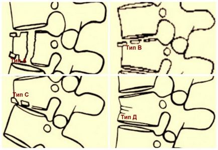 Класифікація переломів хребта в залежності від механізму ушкодження