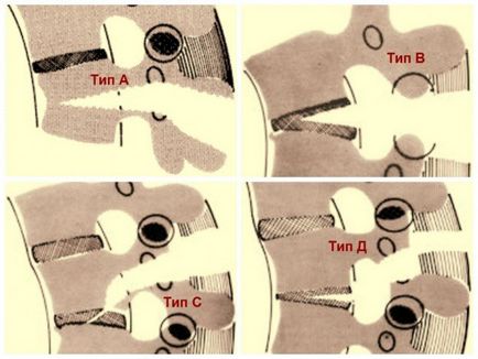 Clasificarea fracturilor vertebrale în funcție de mecanismul de deteriorare
