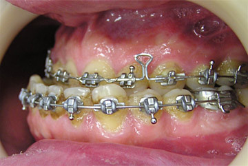 Cazuri clinice de tratament ortodontic