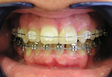 Cazuri clinice de tratament ortodontic