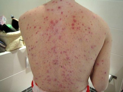 Mikor mossuk után bárányhimlő felnőtt (utána) Mikor mossuk után bárányhimlő felnőtt