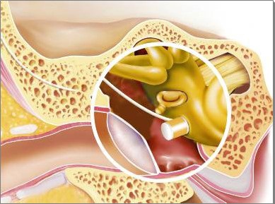 Vezetőképes és vegyes hallásvesztés (konduktív és vegyes hallásvesztés. Az azonnali kezelés középfül implantátum (gyermekgyógyászatban)) Vezetőképes és vegyes halláscsökkenés