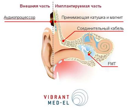 Implantul cohlear