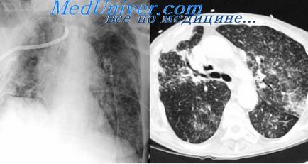 Diagnosticul clinic al tuberculozei