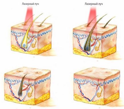 Epilarea cu laser a zonei de bikini (adâncime, extra) este procedura dăunătoare, este dureroasă, consecințele în