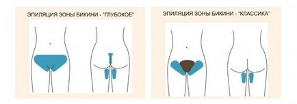 Epilarea cu laser a zonei de bikini (adâncime, extra) este procedura dăunătoare, este dureroasă, consecințele în