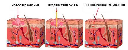 Îndepărtarea cu laser a neoplasmelor de papilome, molare, nevi din Ekaterinburg la prețuri accesibile