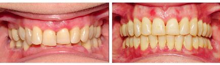 Лікування глибокого прикусу у дорослих ціна, фото, глибокий прикус лікування брекетами у підлітків і