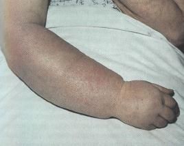 Tratamentul limfostazelor, umflarea mâinilor și picioarelor, g