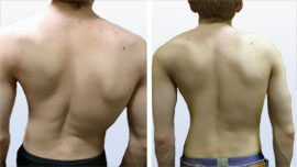 Tratamentul încălcării posturii, scolioză (1, 2, 3, 4 grade) - Centrul European de Vertebrologie