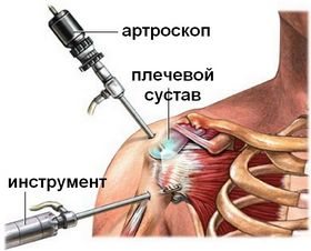 Лікування плечового артриту основні методи