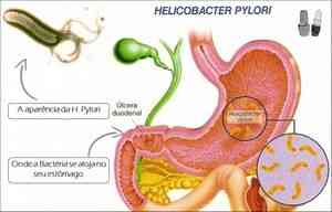 Tratamentul Helicobacter pylori - ulcer peptic -if () - endif - catalog de articole - proctologie