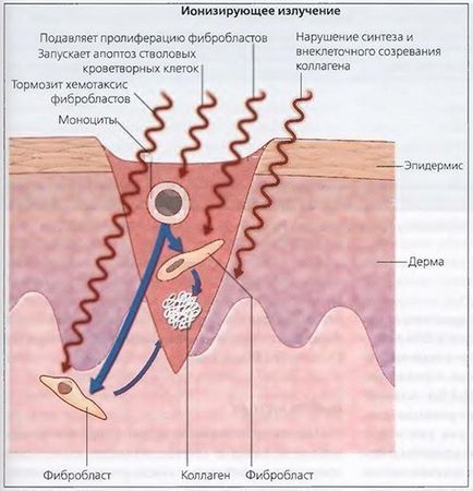 Radioterapia cicatricilor