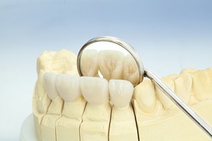 Cea mai bună alegere cermetă între coroane dentare cermet și zirconiu